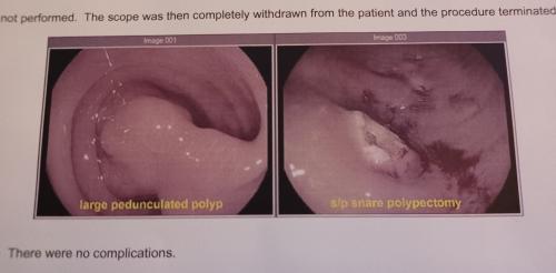 Polyp removal